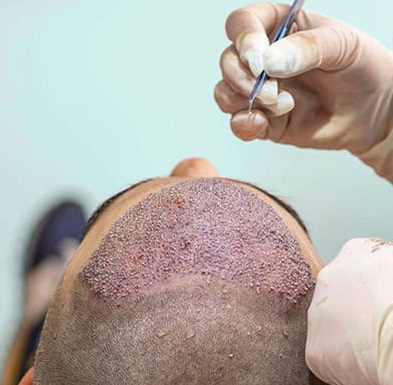 Hair Transplant